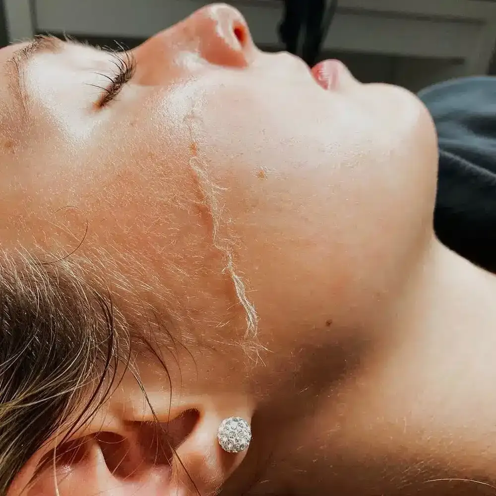 Dermaplaning: Mit einer Klinge werden feine Härchen und Hautschüppchen von der Wange abgetragen